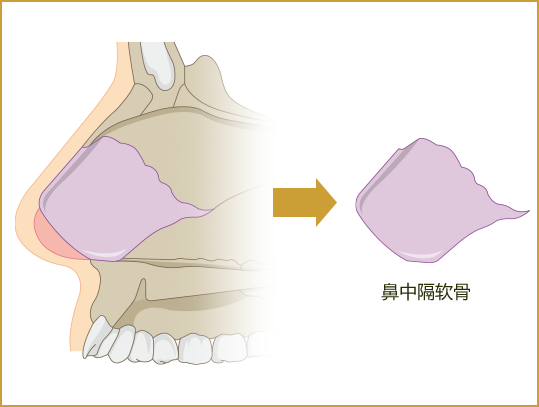 鼻中隔軟骨