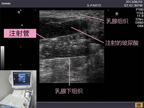 エコー併用注入（オプション）で 正確で安全な施術 画像
