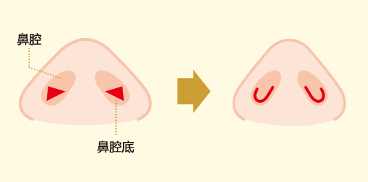 鼻腔内切開