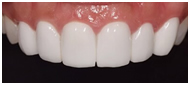 プレミアムダイヤモンドセラミック（ジルコニアセラミック）の歯の画像