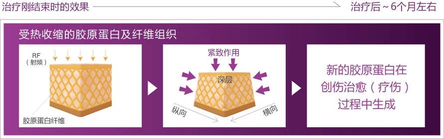 創傷治癒過程でおこる長期的なコラーゲンのリモデリング